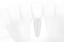 Faded image of dental implant replacing missing tooth