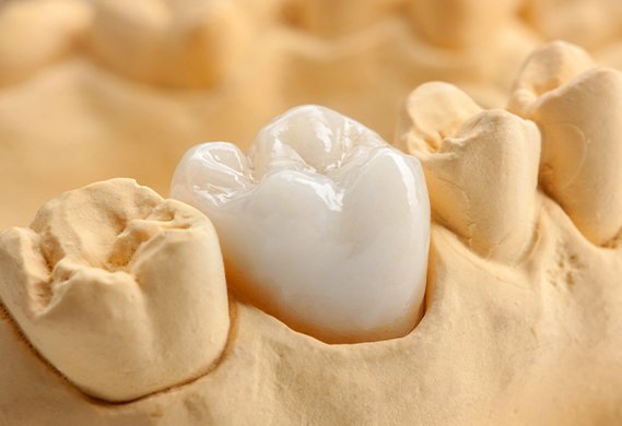 white dental crown