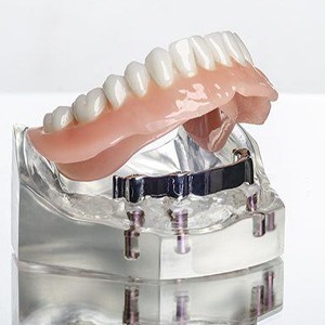 implant denture bottom