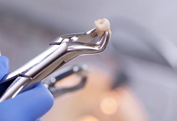 dentist in Houston holding an extracted tooth with dental forceps 
