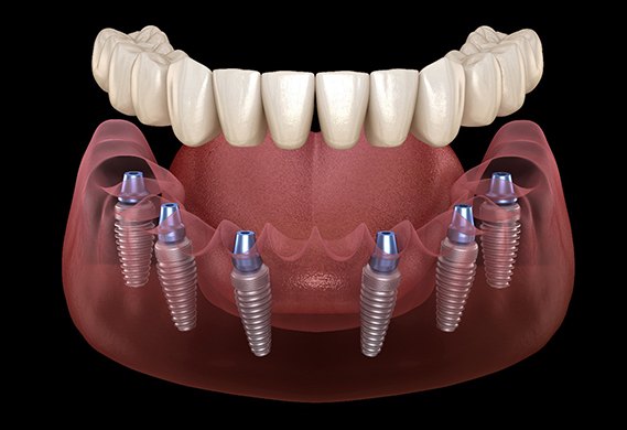 A digital image of 6 dental implants surgically placed along the lower arch and an implant denture placed on top in Houston