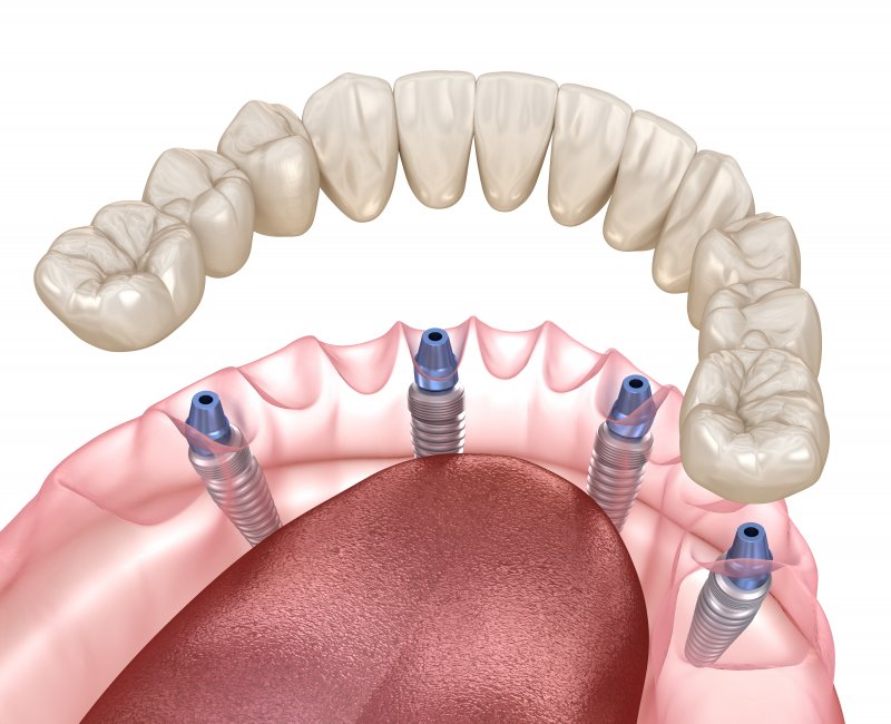 a digital image of an implant denture in Houston restoring the lower arch of the mouth